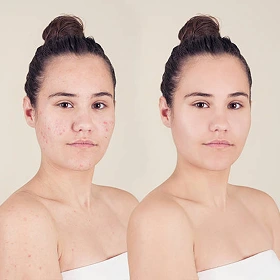 Client receiving chemical peel facial in Horsham at Amanda's Aesthetics