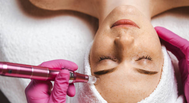 Woman receiving microneedling treatment in Horsham at Amanda's Aesthetics