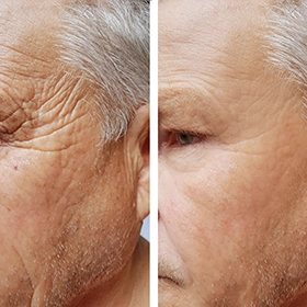 Patient receiving Neurotoxin Injectables in Horsham at Amanda's Aesthetics