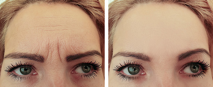 Patient receiving Neurotoxin Injectables in Horsham at Amanda's Aesthetics