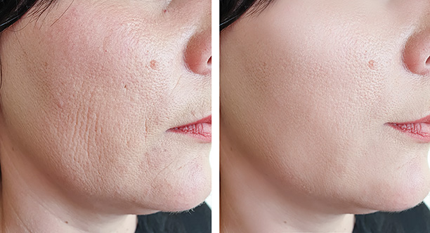 Skin Booster Injection Treatment in Horsham at Amanda's Aesthetics