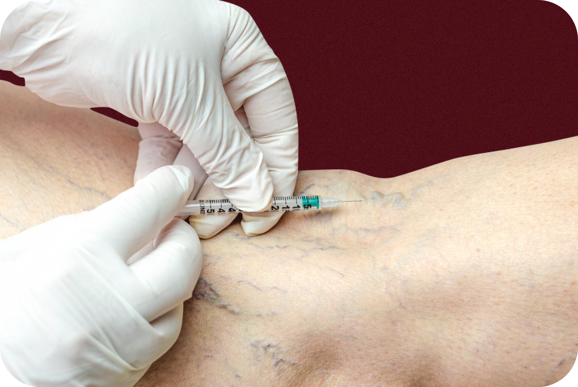 Client receiving sclerotherapy in Horsham at Amanda's Aesthetics